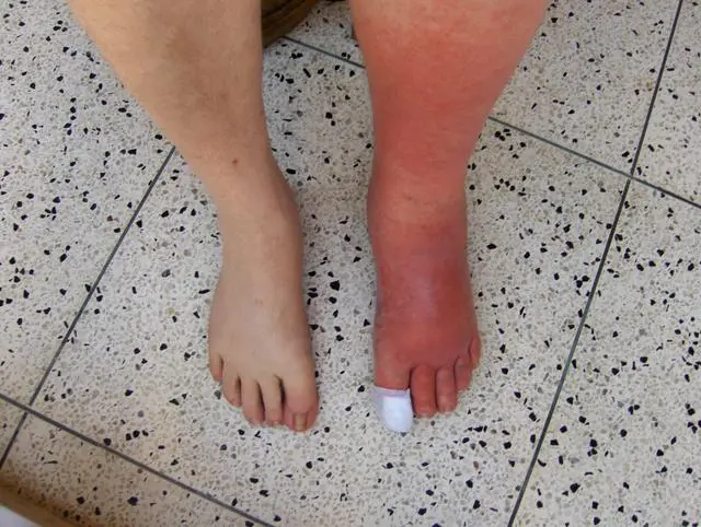 Recurrent Cellulitis: Biological Mechanisms, Barriers to Care, and the Burden of Structural Inequality